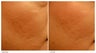 Acne Scarring Correction