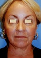 YoungLift ~ Fat Transfer (Full Face)