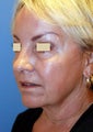 YoungLift ~ Fat Transfer (Full Face)