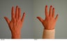 Hand Rejuvenation (with Fat Transfer)