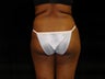 Buttocks Augmentation by Fat Grafting