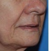 Fat Transfer / Fat Grafting / YoungVolumizer Procedure