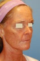 Fat Transfer / Fat Grafting / YoungVolumizer Procedure