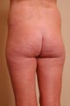 Liposuction w/ Fat to Buttocks