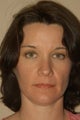 Fat Injections to Cheek & Cheekbone Area, Jawline, Brow & Lips, Botox to Brow.