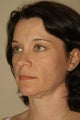Fat Injections to Cheek & Cheekbone Area, Jawline, Brow & Lips, Botox to Brow.
