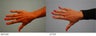 Hand Fat Transfer