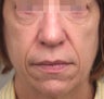 Fat Transfer to Face