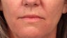 Lip Augmentation