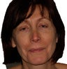 Facial Fat Injections