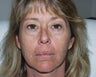 Fat injections and Laser Resurfacing