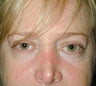 Fat transfer and Skin resurfacing