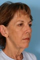 Fat transfer with facelift, eyelid surgery and brow lift