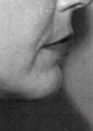 Facial Contouring