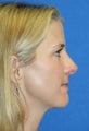 Rhinoplasty and Fat Transfer