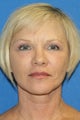 Facelift, Fat Transfer, and Skin Pinch