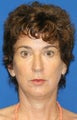 Facelift, Lateral Browlift, Fat Transfer, Chemical Peel