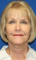Facelift, Fat Transfer, and Skin Pinch