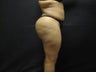 Natural fill to Buttocks