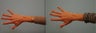 Fat Transfer to hands
