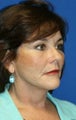 1 month pot-op: Facelift, Necklift, Neck Liposuction, Fat Transfer, and Browlift