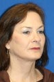 6 months post op: Facelift, Full Face Fat Transfer, Upper Blepharoplasty, Lower Eyelid Skin Pinch, & Chemical Peel