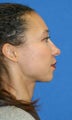 Full Face Fat Transfer