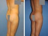 Fat Transfer 
