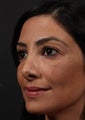 Facial fat grafting