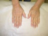 Fat transfer to the hands