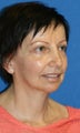 Facelift, Fat Transfer, Upper Bleph, Lower Eyelid Skin Pinch