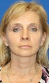 Facelift, Fat Transfer, Lateral Browlift, Lower Eyelid Skin Pinch