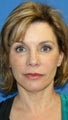 Facelift with Extended Necklift, Lateral Browlift, Fat Transfer, and Skin Pinch