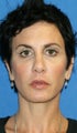 Peri-orbital Fat Transfer, Upper Blepharoplasty, & Skin Pinch
