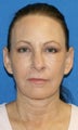 Facelift with Extended Necklift, Fat Transfer, Upper Blepharoplasty and Skin Pinch