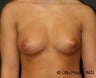 Breast Augmentation with Fat Grafting 
