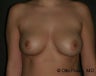 Fat Grafting for Breast Augmentation