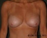 Breast Augmentation with Fat Grafting