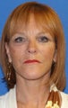 Facelift with Extended Necklift, Fat Transfer, and Skin Pinch