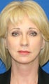 Facelift, Fat Transfer, Upper Bleph, Lower Eyelid Skin Pinch