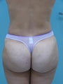 Fat Transfer