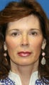 Facelift, Fat Transfer, and Skin Pinch