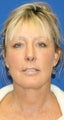 Facelift with Extended Necklift, Fat Transfer, Upper Blepharoplasty & Lower Eyelid Skin Pinch