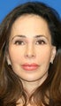 Short Incision Facelift and Fat Transfer