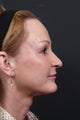 Facial fat grafting