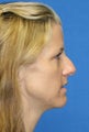 Rhinoplasty and Fat Transfer