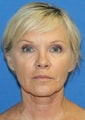 Facelift, Fat Transfer, and Skin Pinch