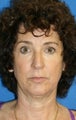 Facelift, Lateral Browlift, Fat Transfer, Chemical Peel