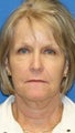 Facelift, Fat Transfer, and Skin Pinch