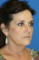 1 month pot-op: Facelift, Necklift, Neck Liposuction, Fat Transfer, and Browlift